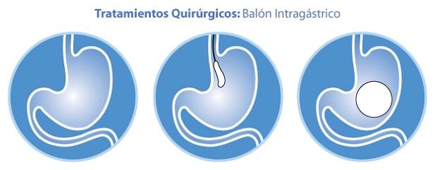 balón intragástrico, digestivo López-Nava, balón gástrico, Madrid, Sevilla, Zaragoza, Valladolid